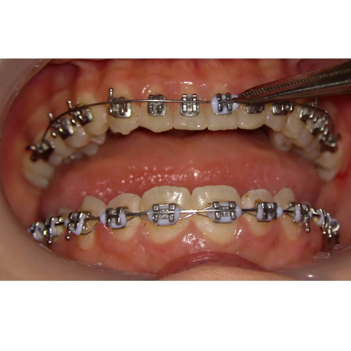 JJ Ortho Reverse Curve NiTi Archwires Natural Form - Round
