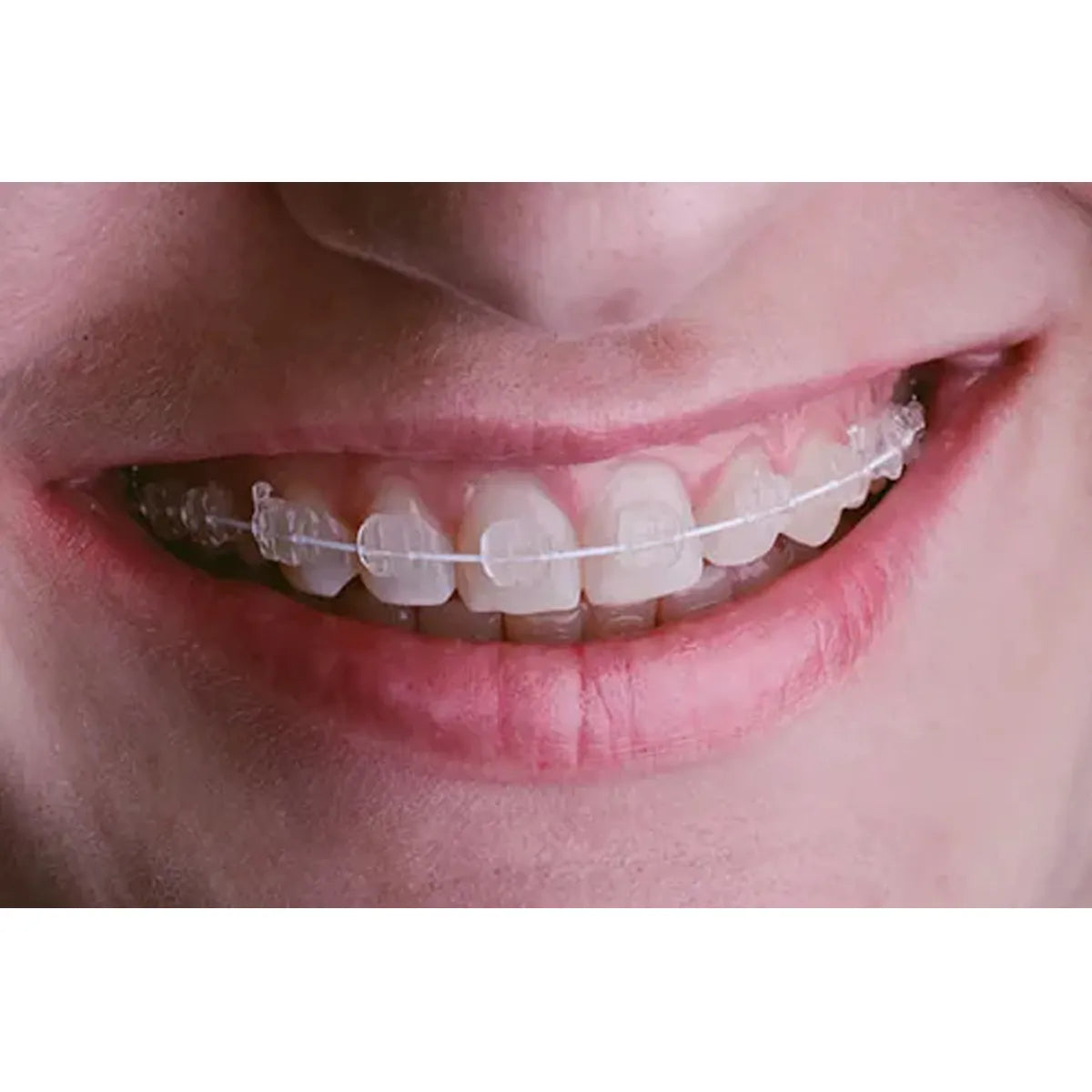 JJ Ortho Selfy Tooth Color Patient Set Wires