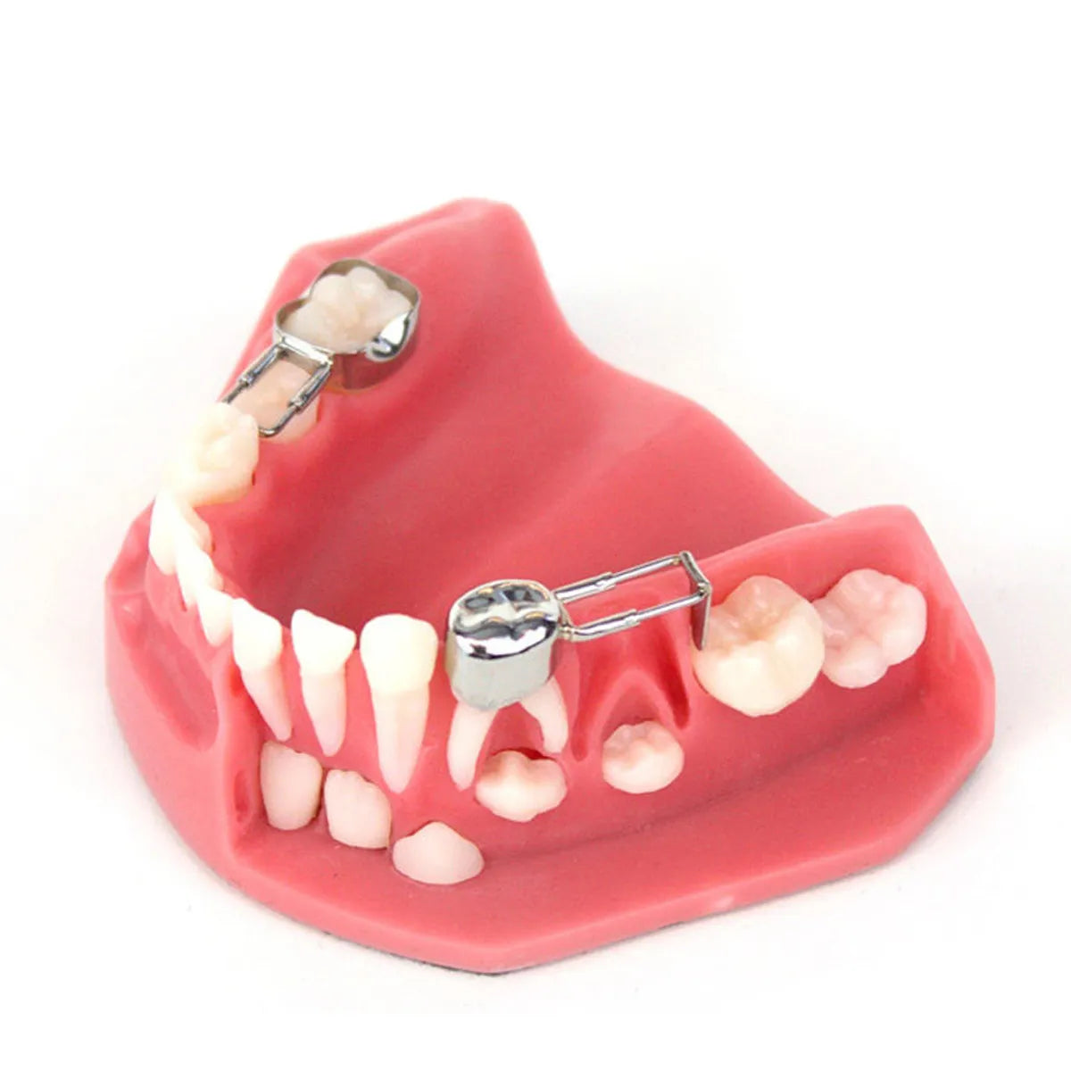 Kids-e-Dental Space Maintainer Band Refills