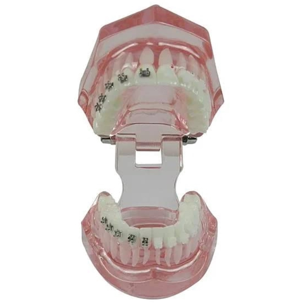 Metro Orthodontics Begg Series Light-wire Bondable Flat Metal Conventional Brackets