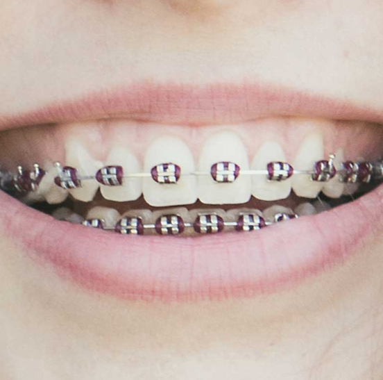 Metro Orthodontics Ovoid Rectangular Lingual NiTi Archwires - Upper 0.017 x 0.025