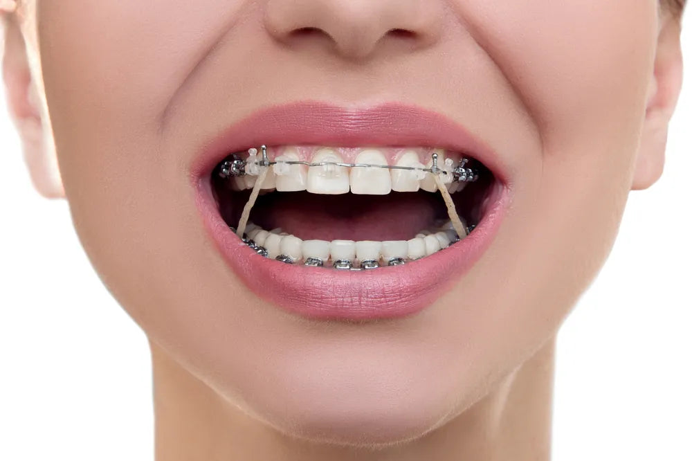 Penta Ortho Intraoral Elastics - Heavy (Pack of 1000)
