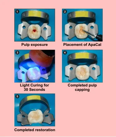 Prevest ApaCal ART