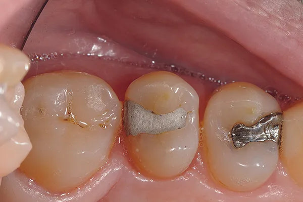 Prevest DenPro Crysta Silver GIC