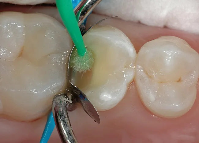 Prevest Denpro Fusion Bond 7