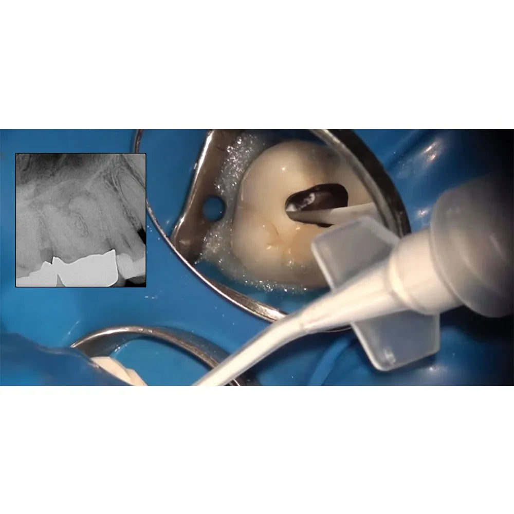 Prime Dental Prime MTA Bioceramic Root Canal Sealer