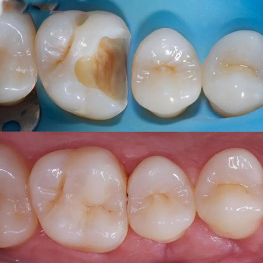 Prime Dental Restorite Bulk Fill Kit (Packable)