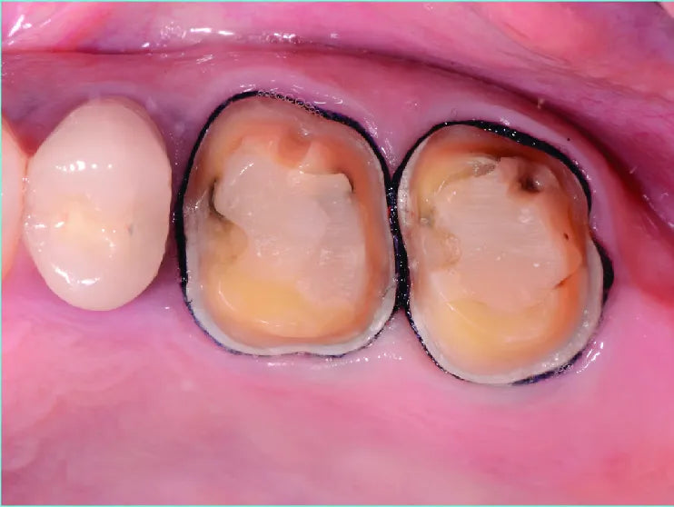 Prime Dental Retra Gel