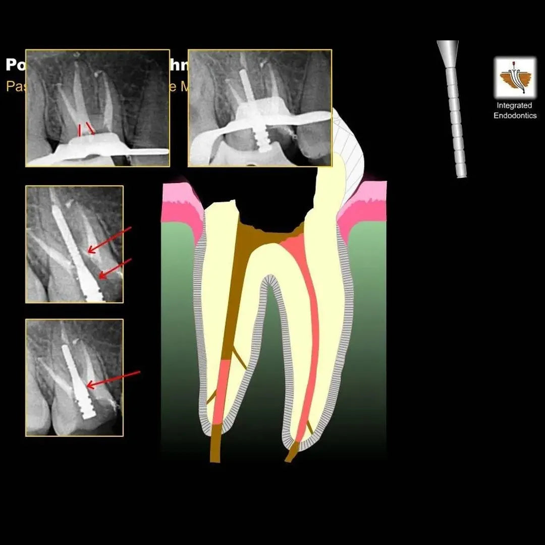 Prime Dental i Post Endodontic Metal Post Refills