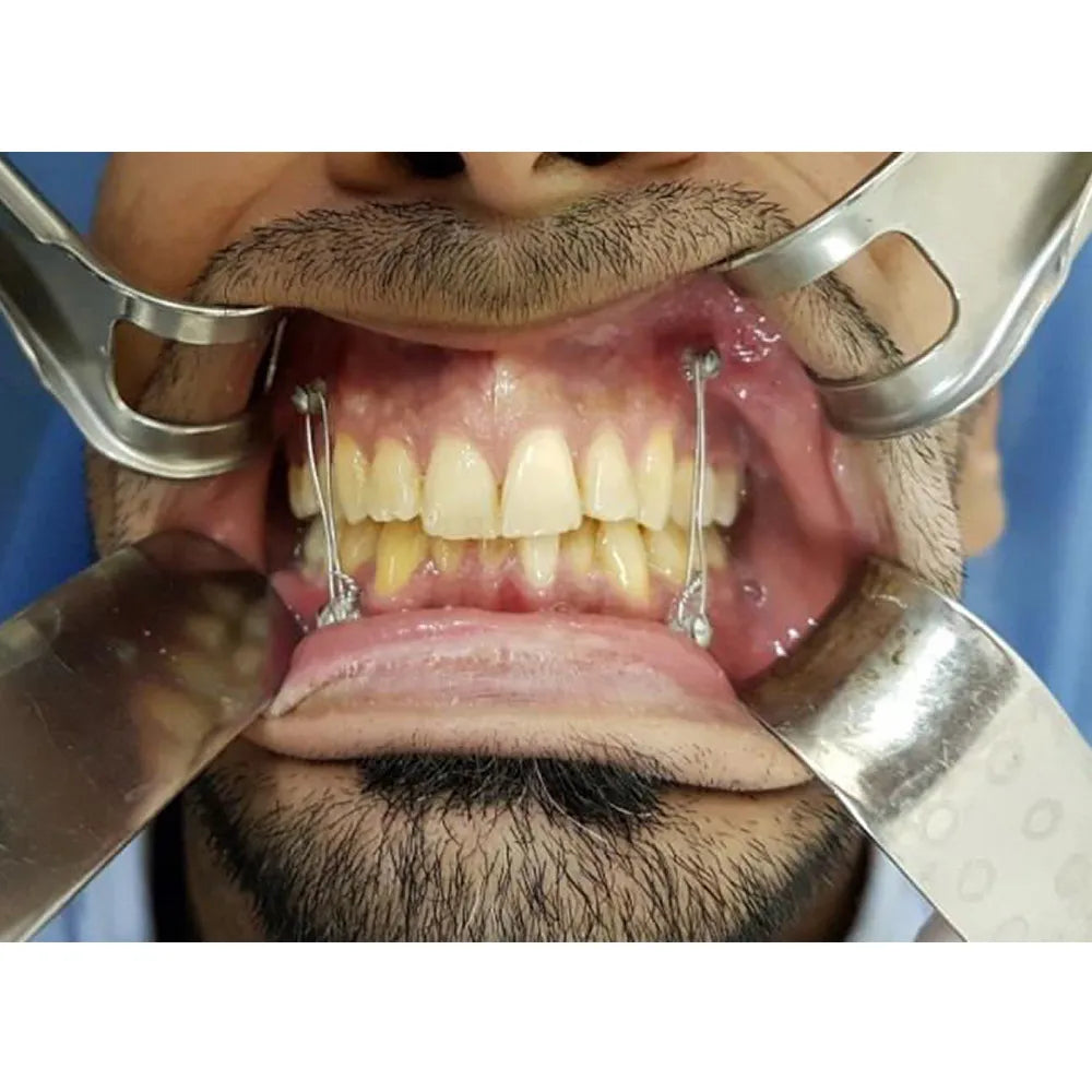 SK Surgicals SS IMF Screws