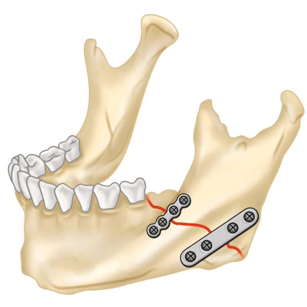 SK Surgicals SS Mini Bone Plates Continuous - 2mm