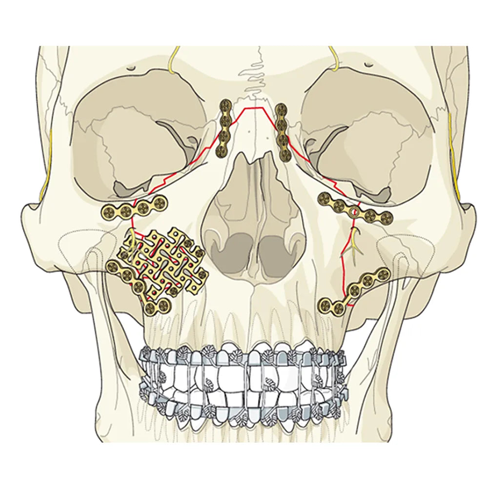 SK Surgicals SS Mini Bone Plates Orbital Continuous - 2mm