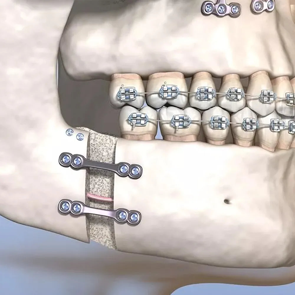 SK Surgicals SS Mini Bone Plates With Gap - 2.5mm