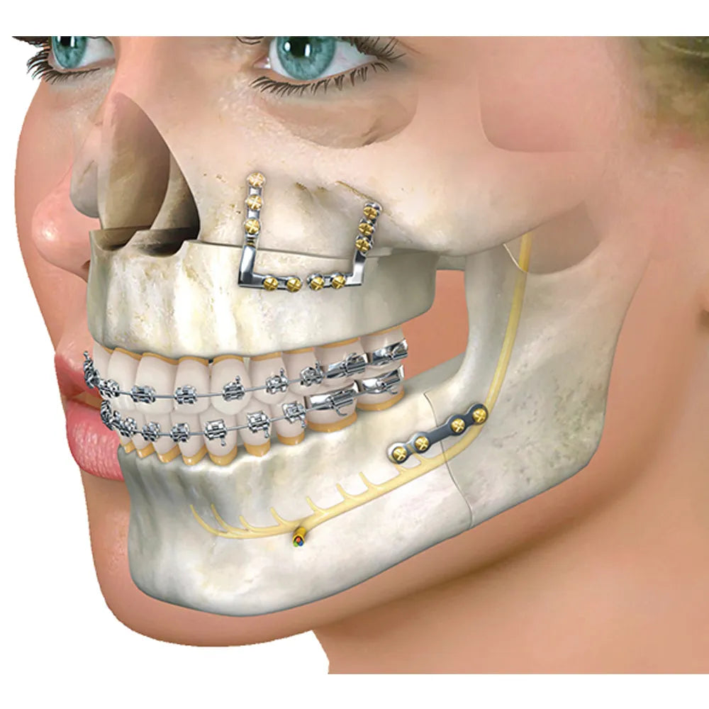 SK Surgicals SS Mini Bone Plates With Gap - 2.5mm