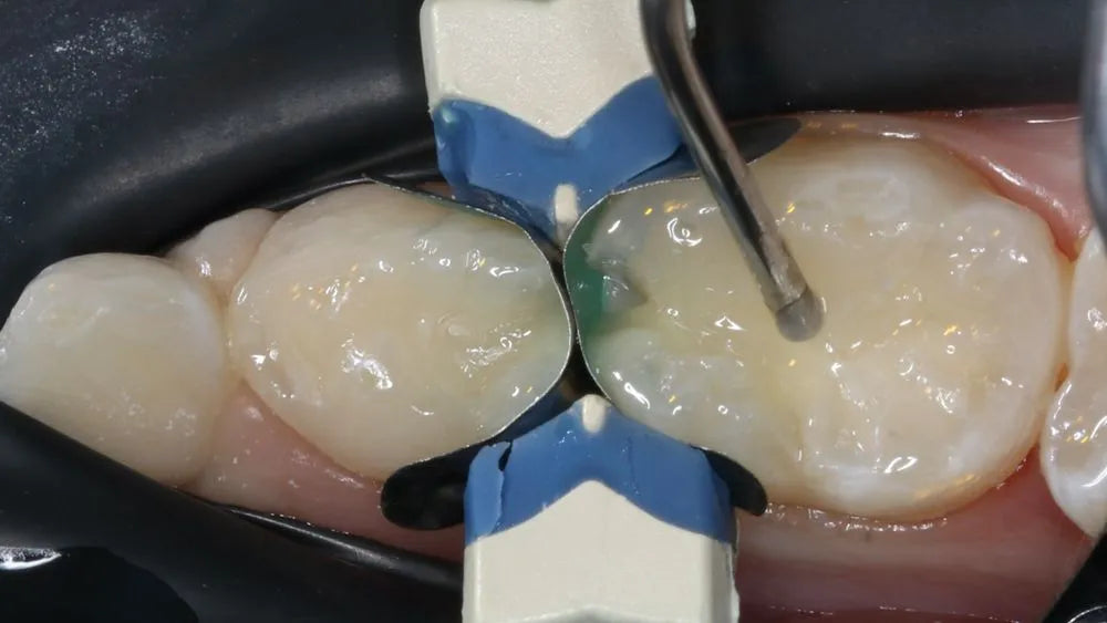 SafeEndo ReCreate LC Flow