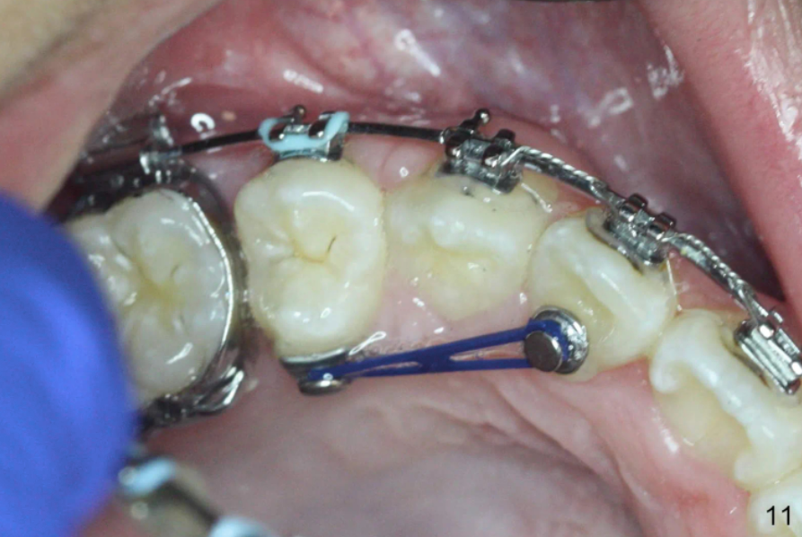 Metro Orthodontics Bondable Buttons Band Attachment