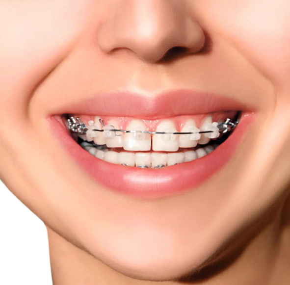 Metro Orthodontics Round Tooth Coloured Super Elastic NiTi Archwires