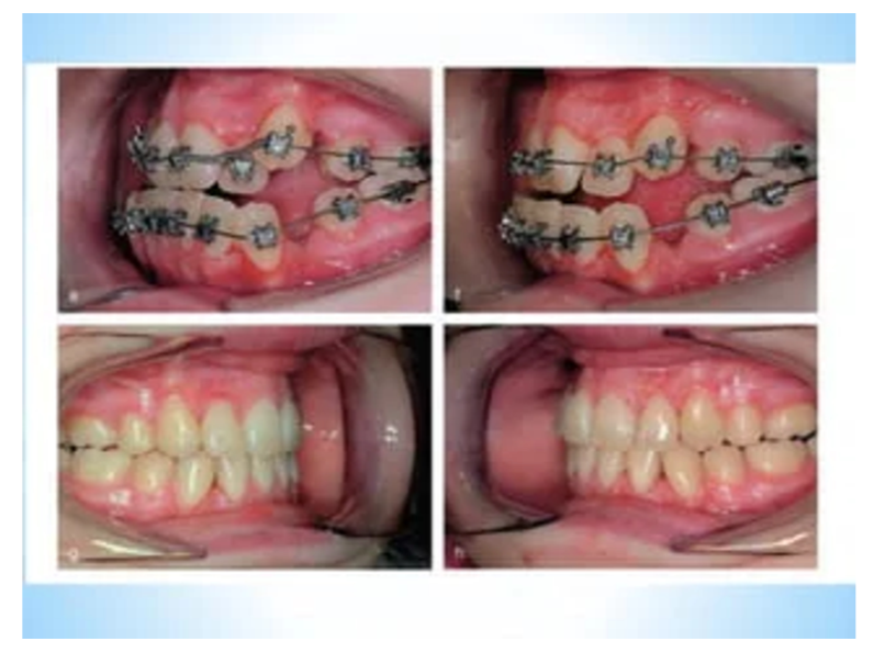 Metro Orthodontics Box of 240 Beggs (Round-Tubed) Orthodontic Bands