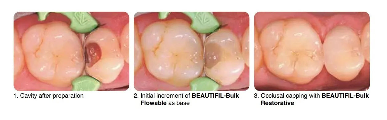 Shofu Beautifil Bulk Flowable Composite