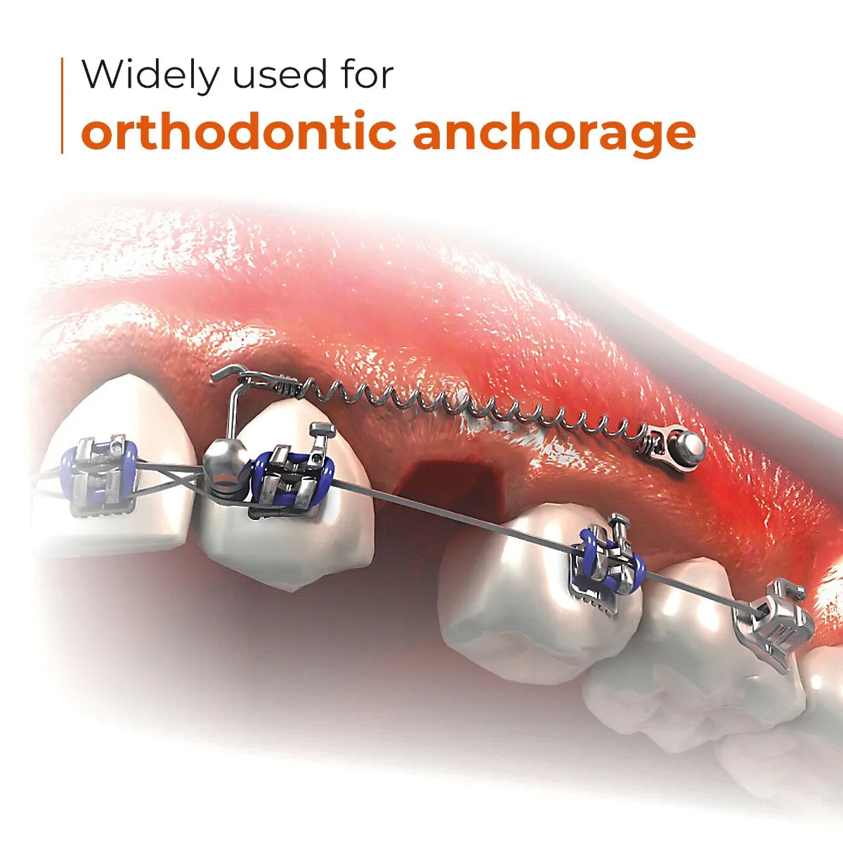 UU Ortho Titanium Mini Implant