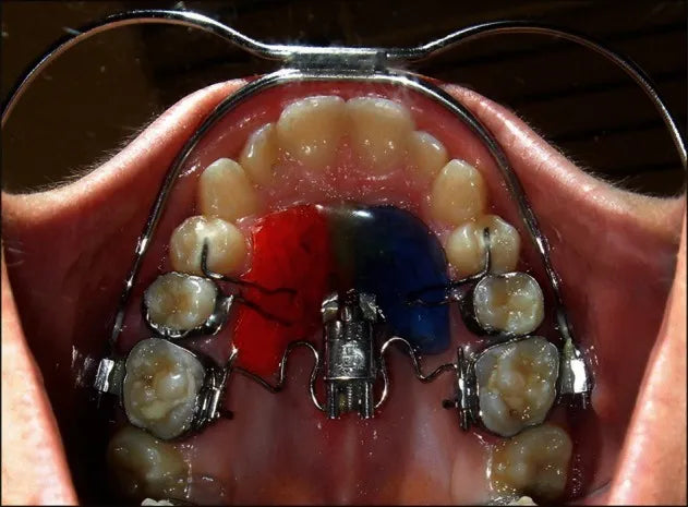 U Ortho Facebow Standard