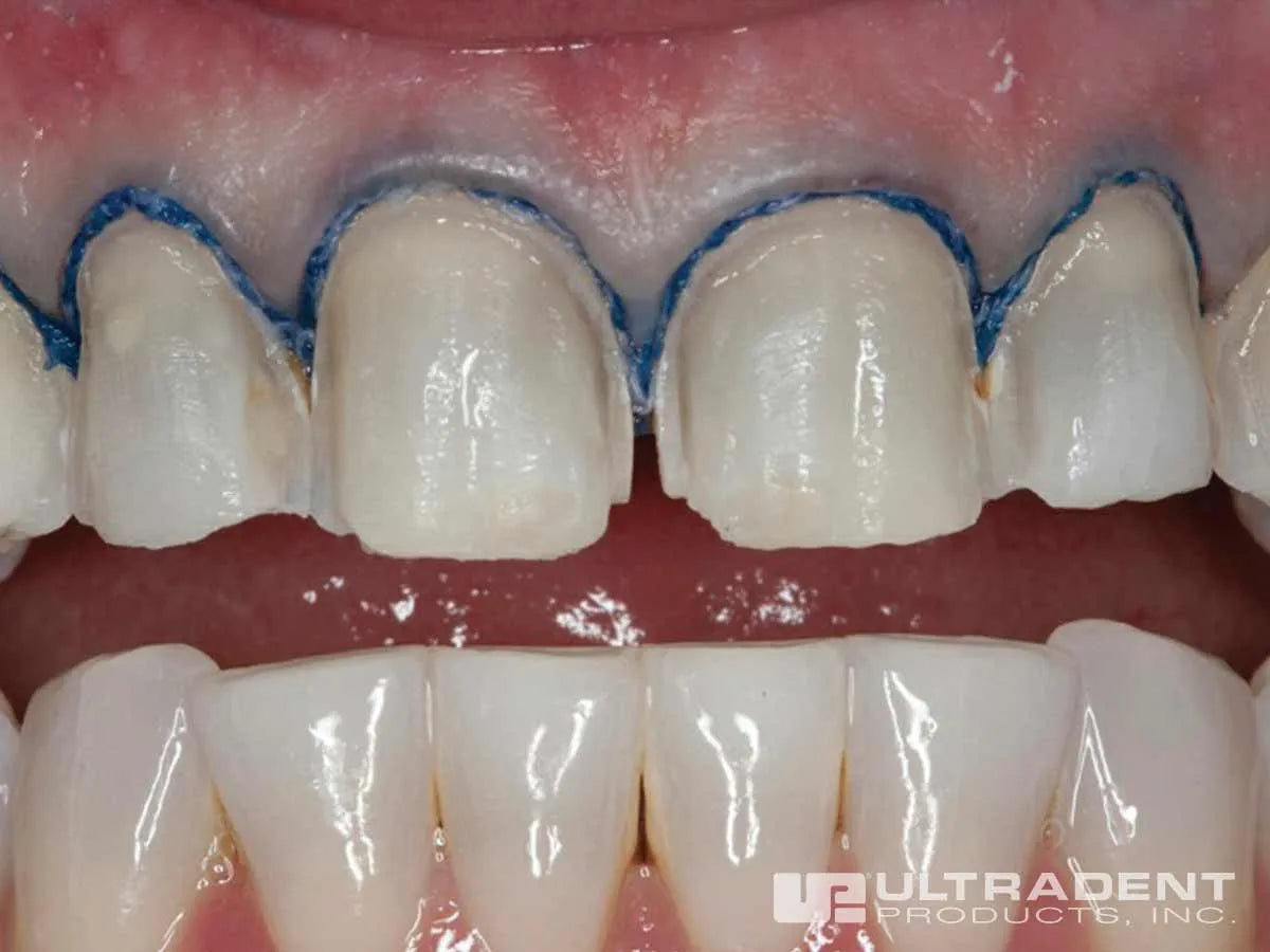 Ultradent Fischer's Ultrapak Packer