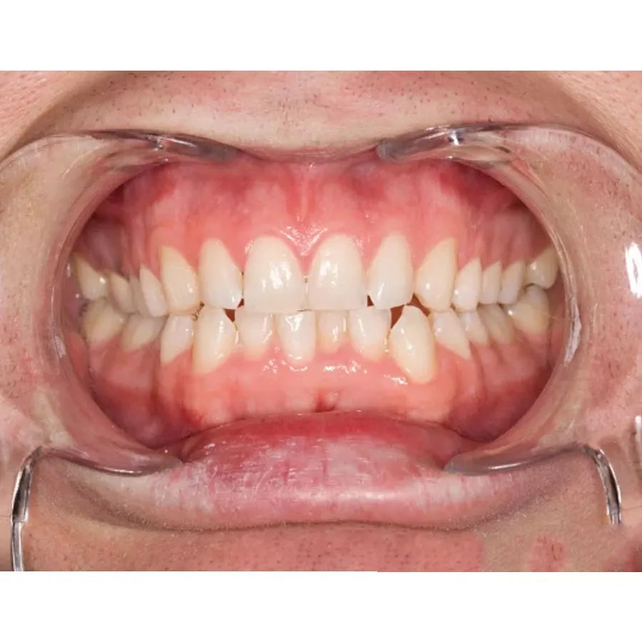 Ultradent Kleerview Retractors