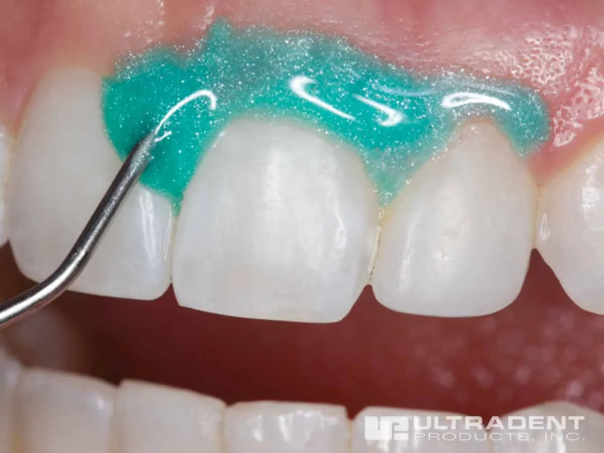 Ultradent Opaldam Green Gingival Barrier
