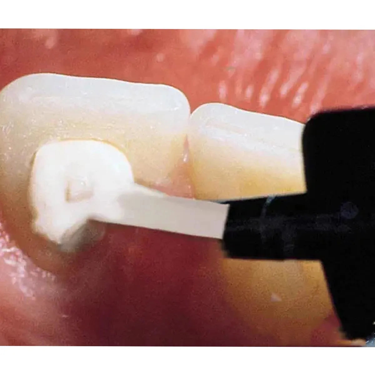 Ultradent Opalescence Endo Mini Refill 1Pk # 1323-1