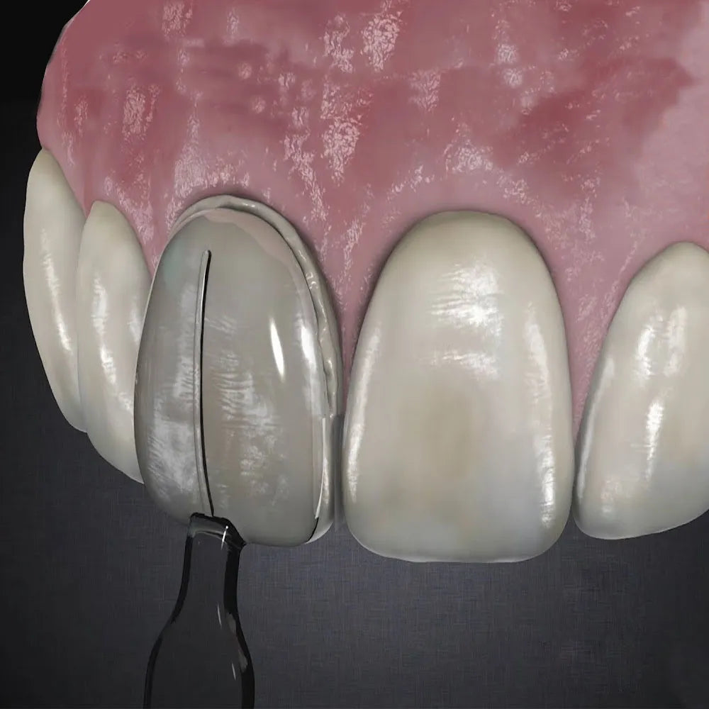 Ultradent Uveneer Template Refills