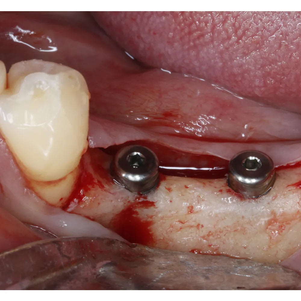 Xcem Dental Implant Submerged Healing Abutment 4.5mm
