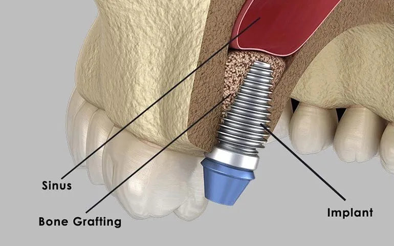 Xcem Osspore Synthetic Bone Grafts HA / B-TCP Mix In Syringe