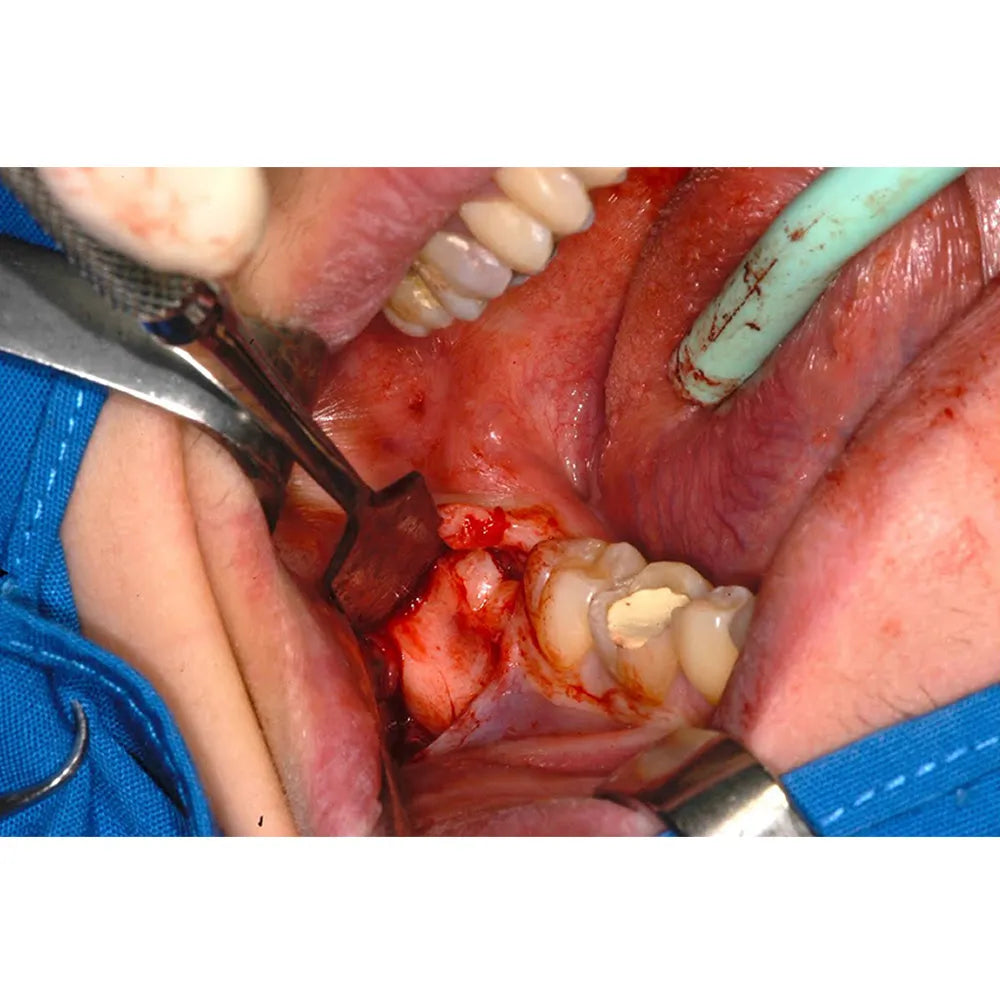 GDC Austin Cheek Retractor Halfmoon (Tra3)