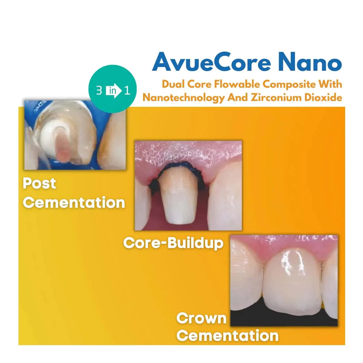 Avue Core Nano (2 Syringe x 5ml) DA0601