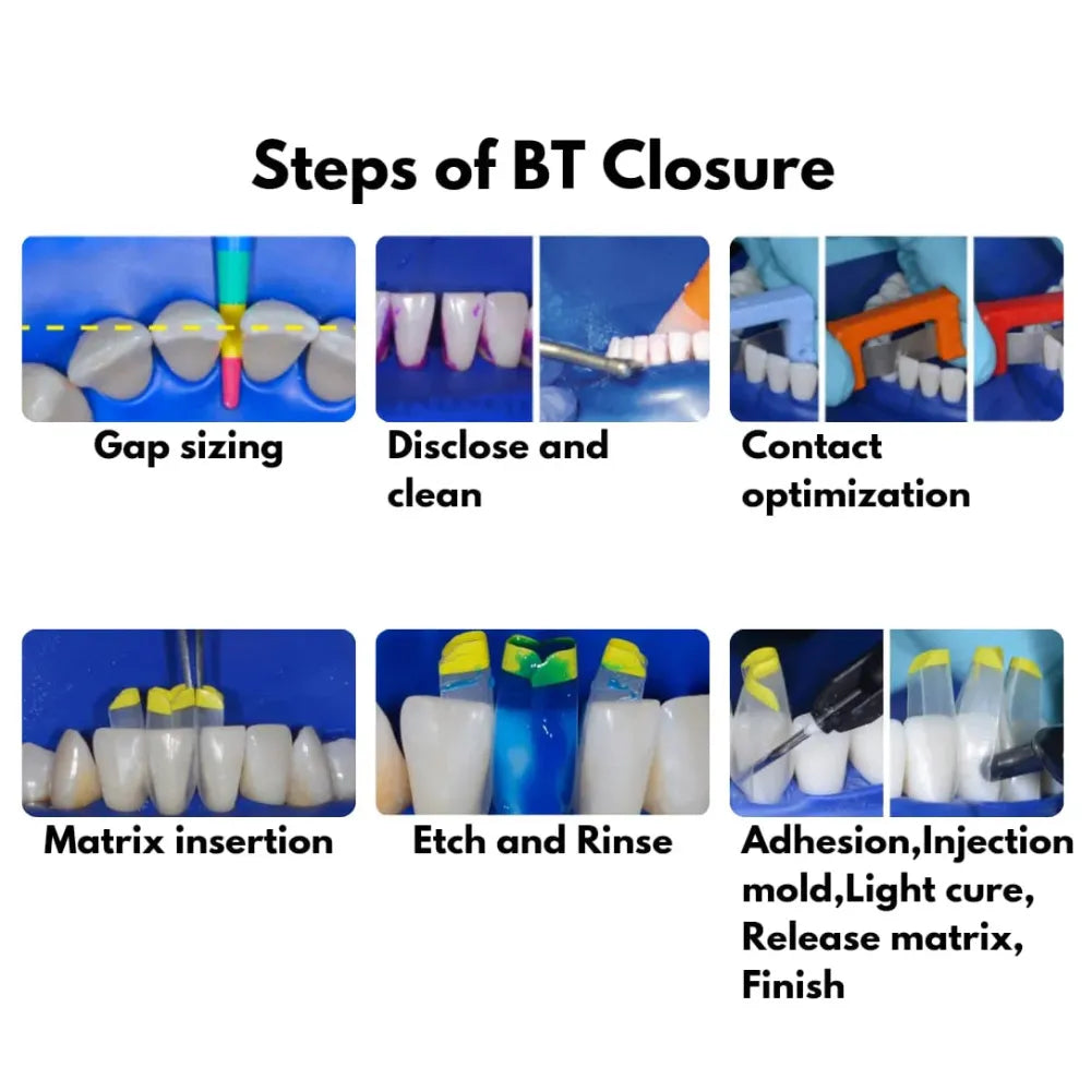 Bioclear Black Triangle (BT) Matrix System Kit