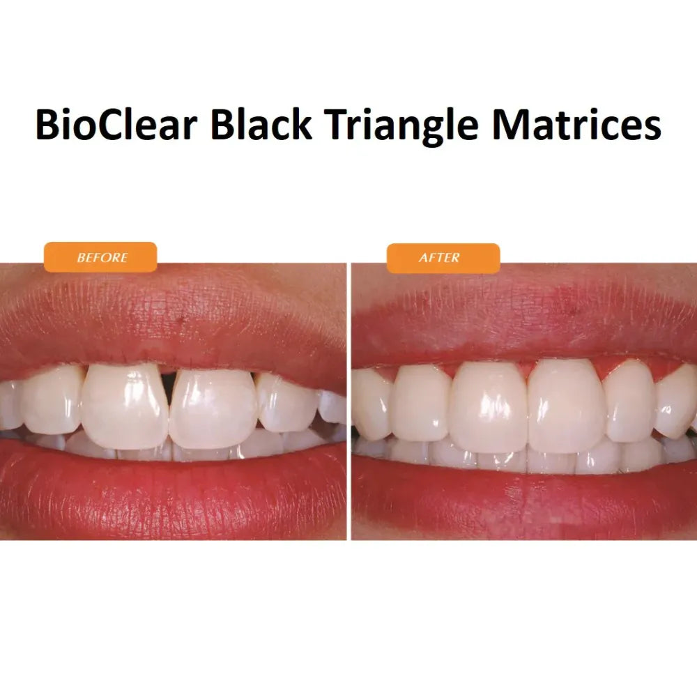 Bioclear Black Triangle (BT) Matrix System Kit
