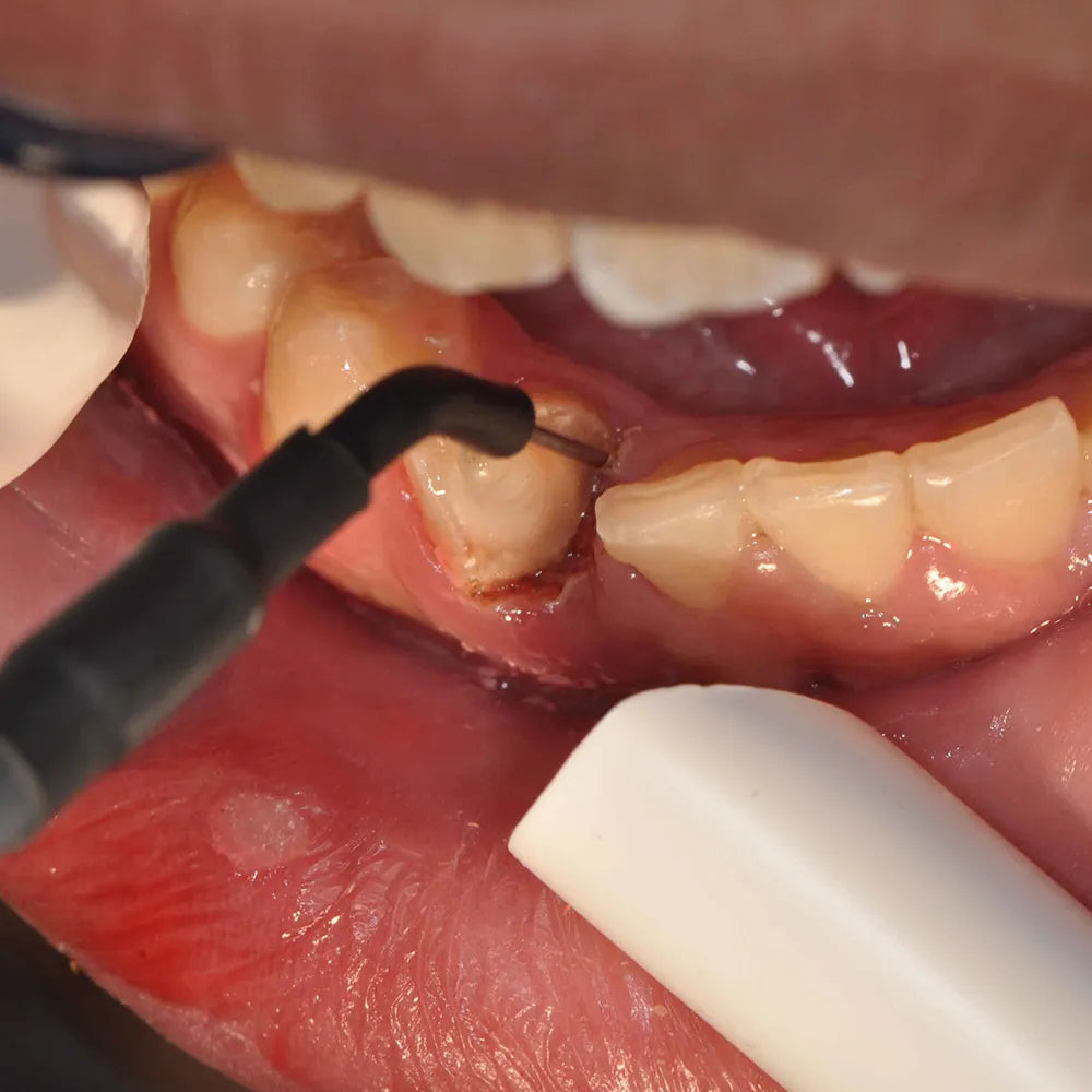 HICAM Intraoral Dental Camera With Screen And Tft Clamp(free)