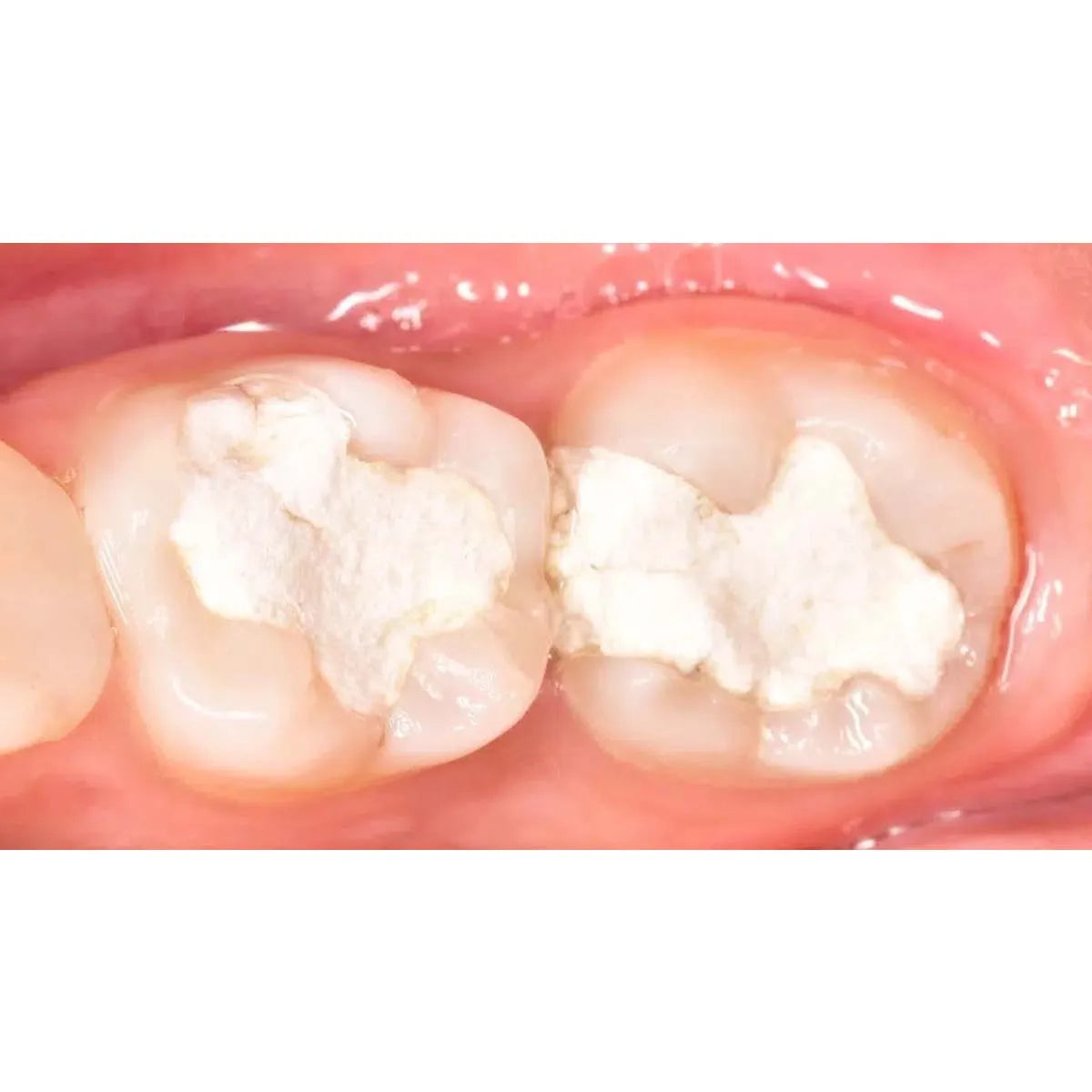 Prime Dental Zinc Oxide Powder - 100gm