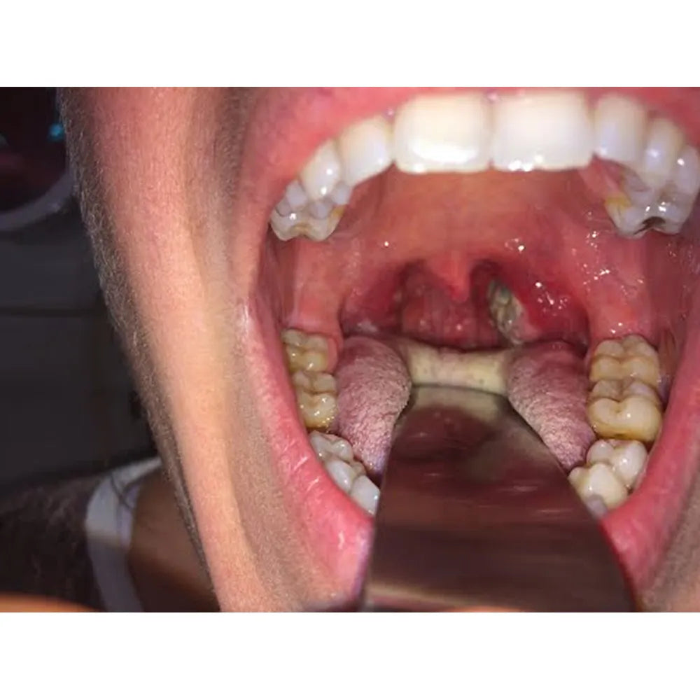 GDC Hartmann Retractor - 72x24mm (15cm) (Crh)