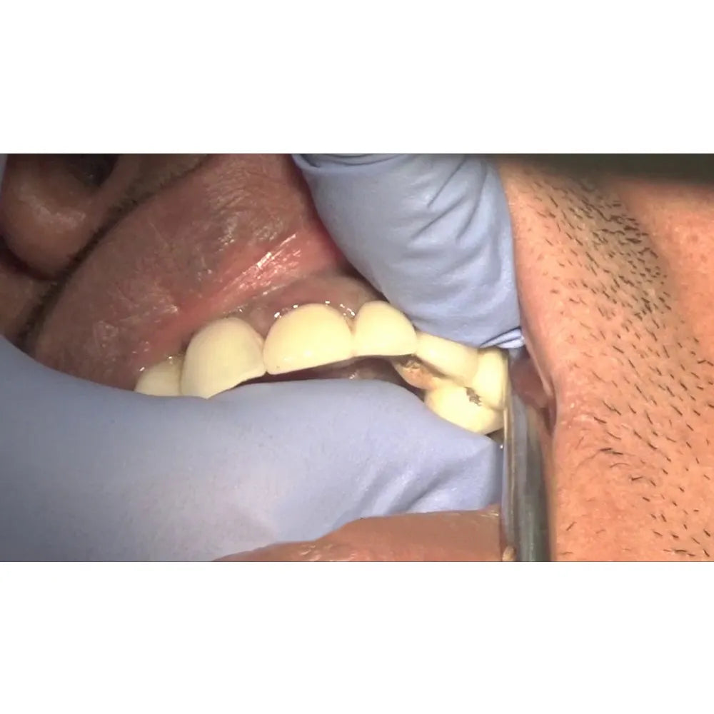 GDC Automatic # Premium Crown Remover (Crp)