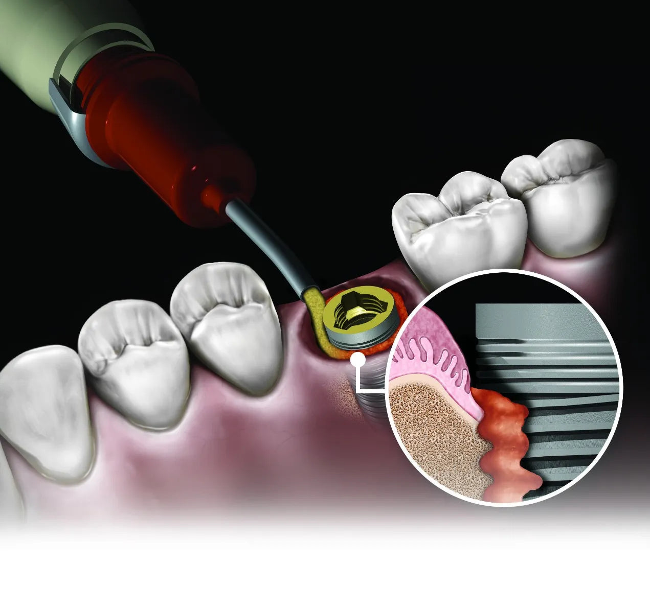 Novabone Dental Putty Cartridge Form