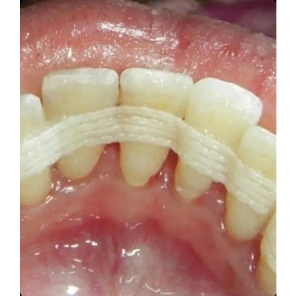 DentAct Fiber Splint 14cm