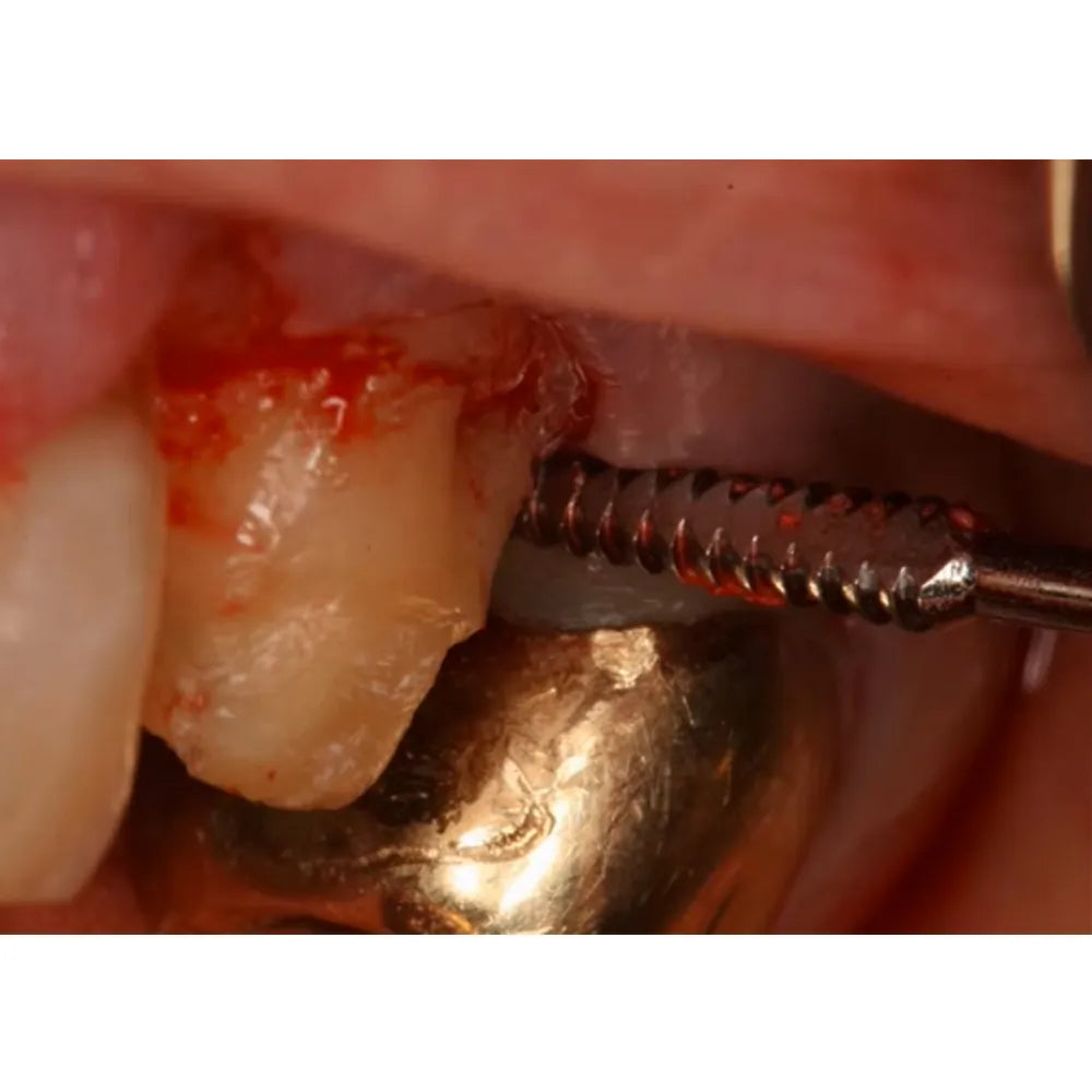 GDC Periodontal Sugarman Bone File#6 (Fs3/4s)