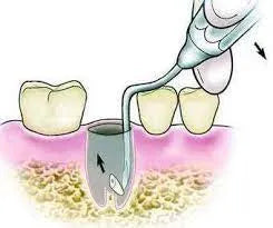 GDC Root Elevators Root Tip Pick Heidbrink - Left (Ehb2)