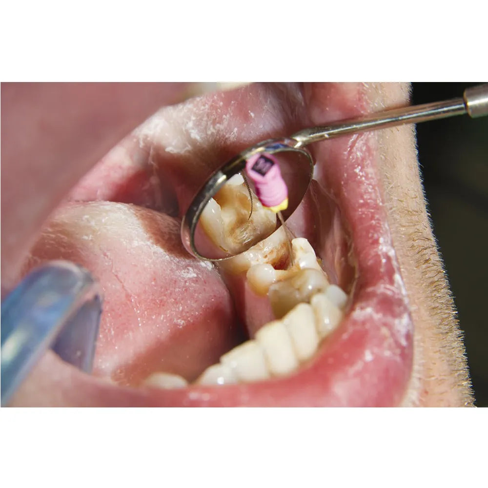 GDC Mouth Mirror Tops Plain Pack Of 12 Pcs - 4 (Mmtp4)