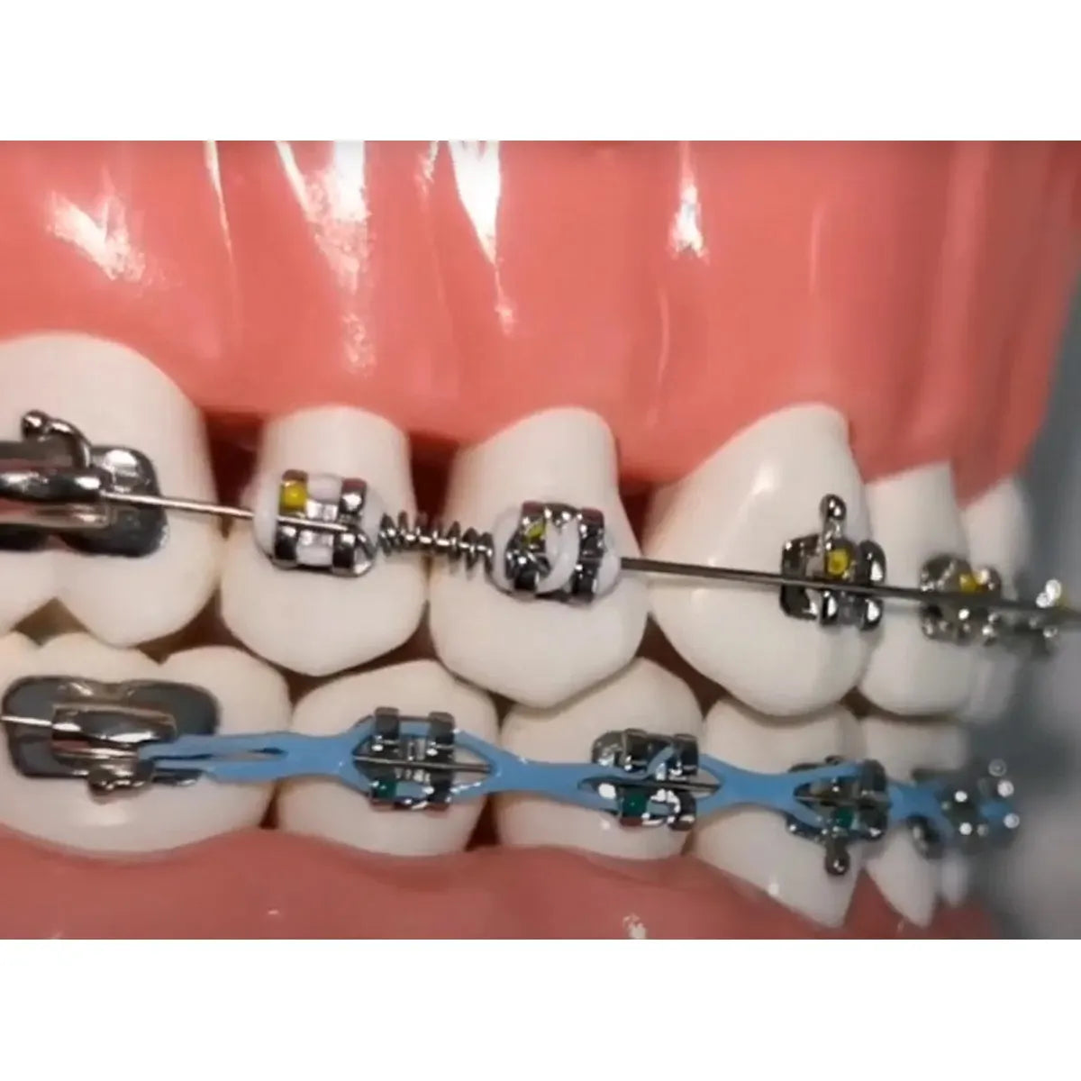 OrthoMetric Flexy NiTi Orthodontic Spring