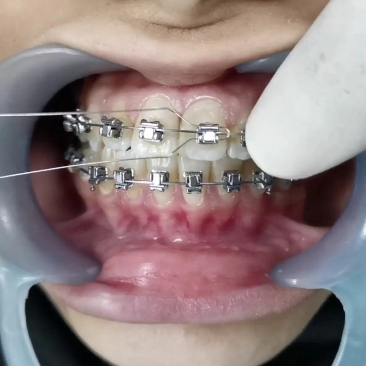 OrthoMetric SS Round Ligature Wire (40g)