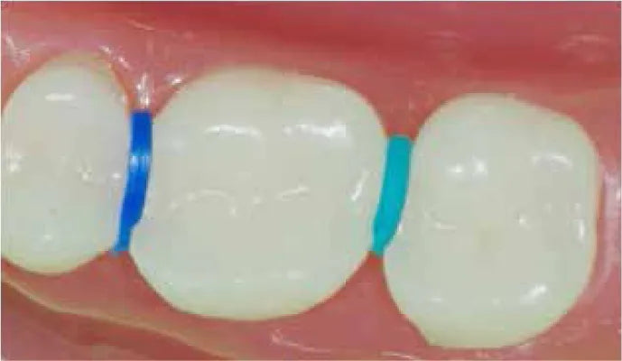 OrthoMetric Elastomerics Ring Separator (Pack of 1000)