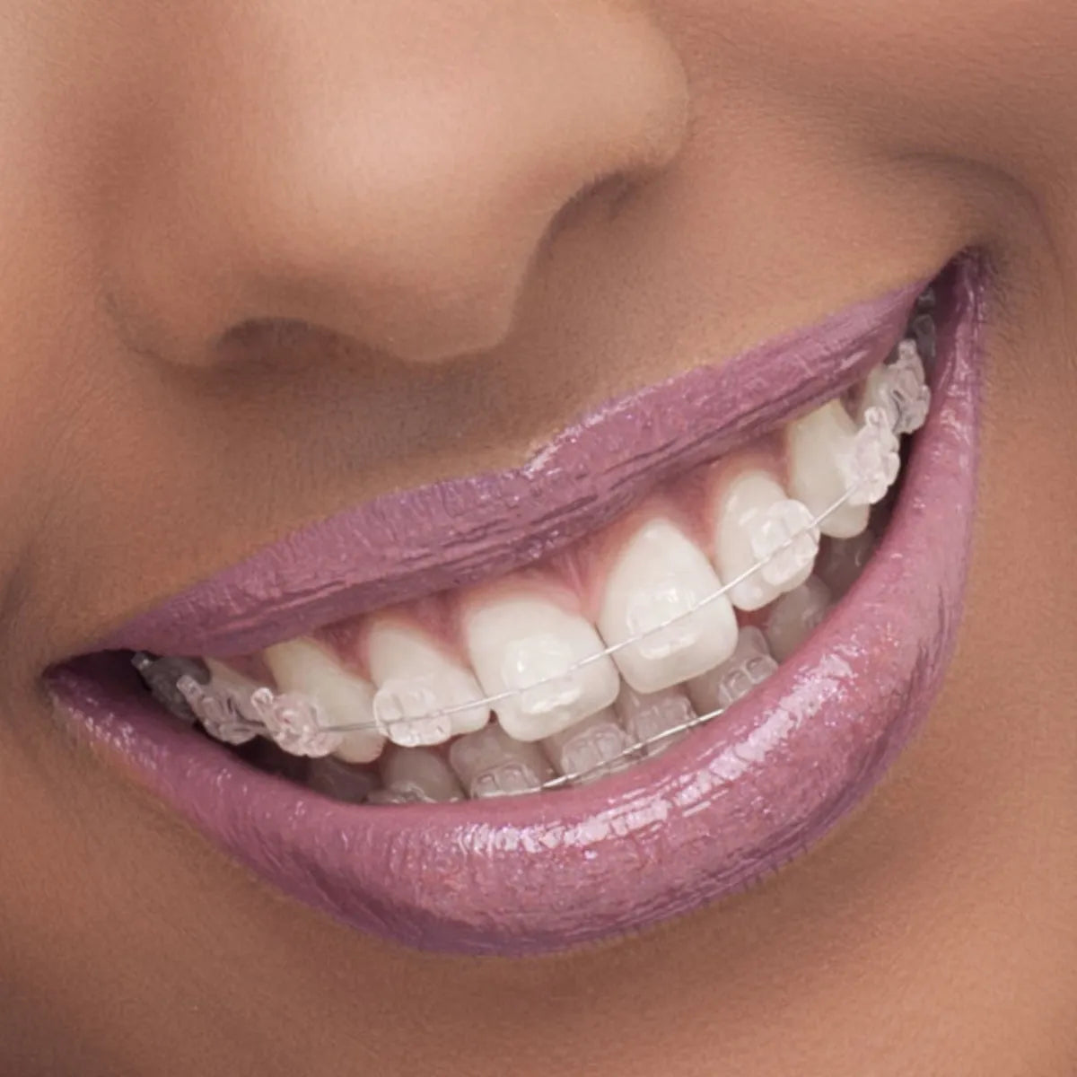 OrthoMetric Iceram-S Monocrystalline Ceramic Bracket MBT 022 - (10.91.2000)