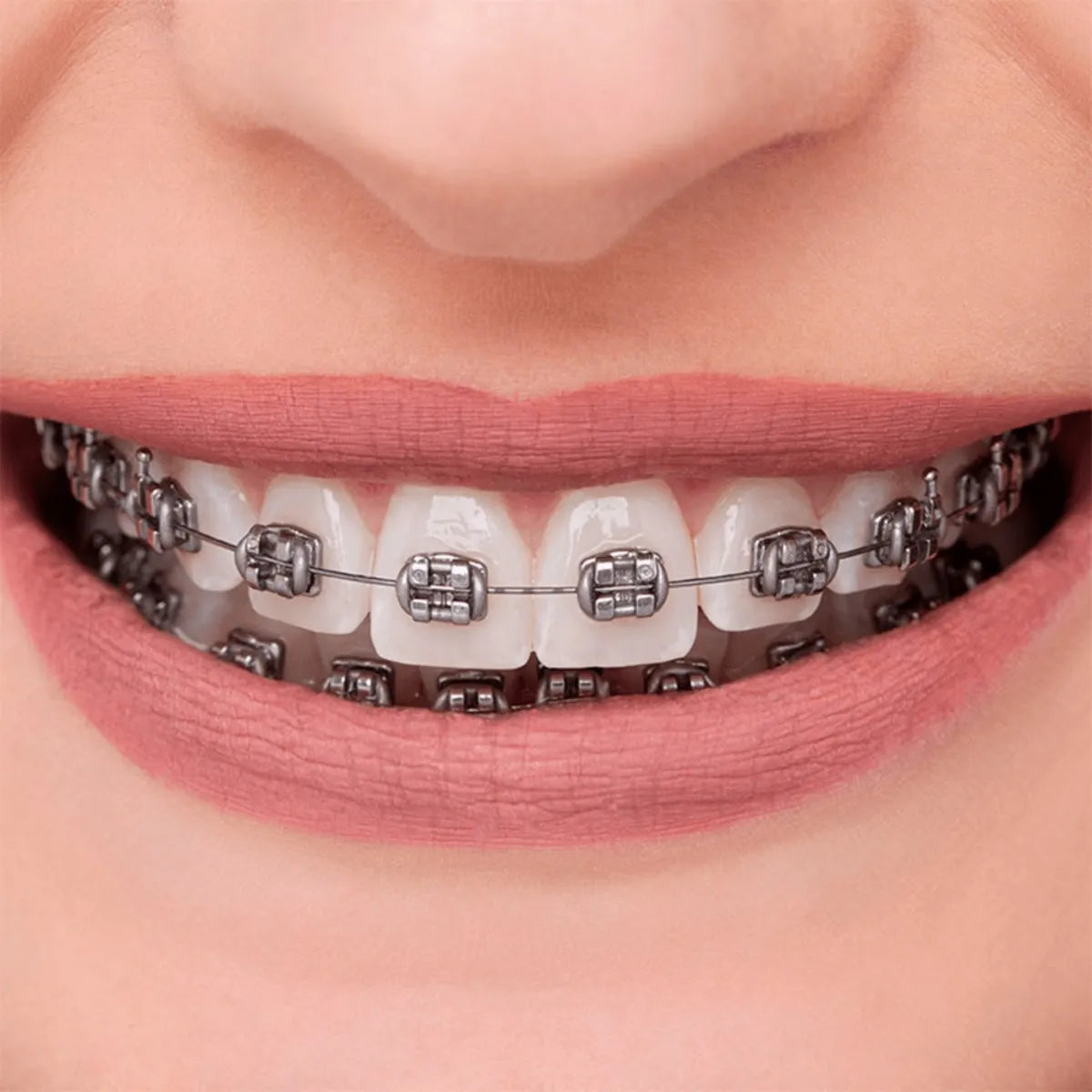 OrthoMetric Advanced Series Metal Bracket Promotional Kit MBT 022 - 10 Cases + Archwires + Stick Ligatures (10.11.2802)